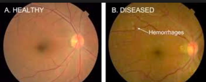 Comparing images to diagnose diabetic retinopathy (Image: Google)